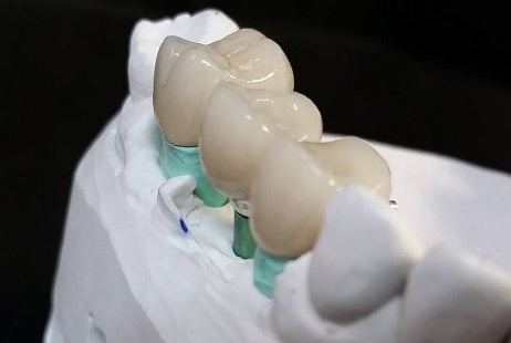 Best Dental Crown Dentists in Bergen County at West Ridgewood Dental Professionals.jpg
