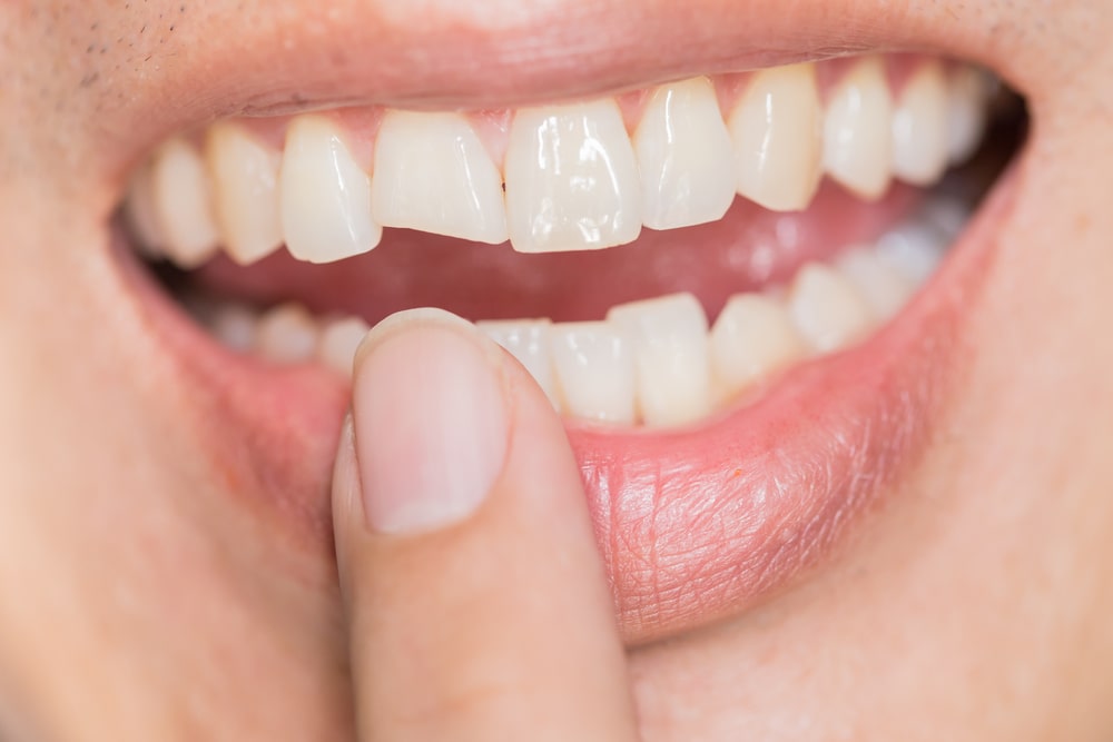 Repair Options for a Broken Tooth - Valley Neighborhood Dental