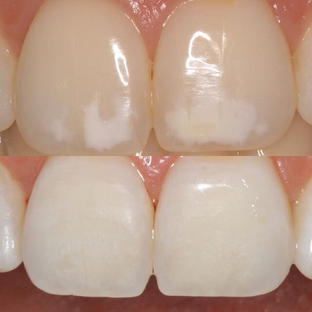 Developmental discoloration can be addressed without drilling. This patient said she was teased as a child and after finding out about a non-invasive treatment she was ready to improve her smile before her wedding day. 1 hour, no drilling, no veneers