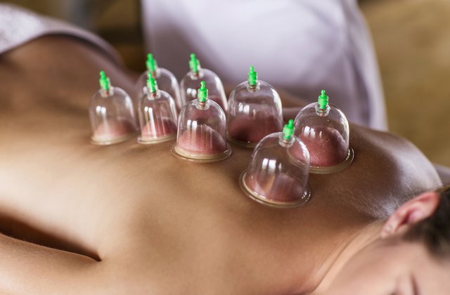 cupping1.jpeg
