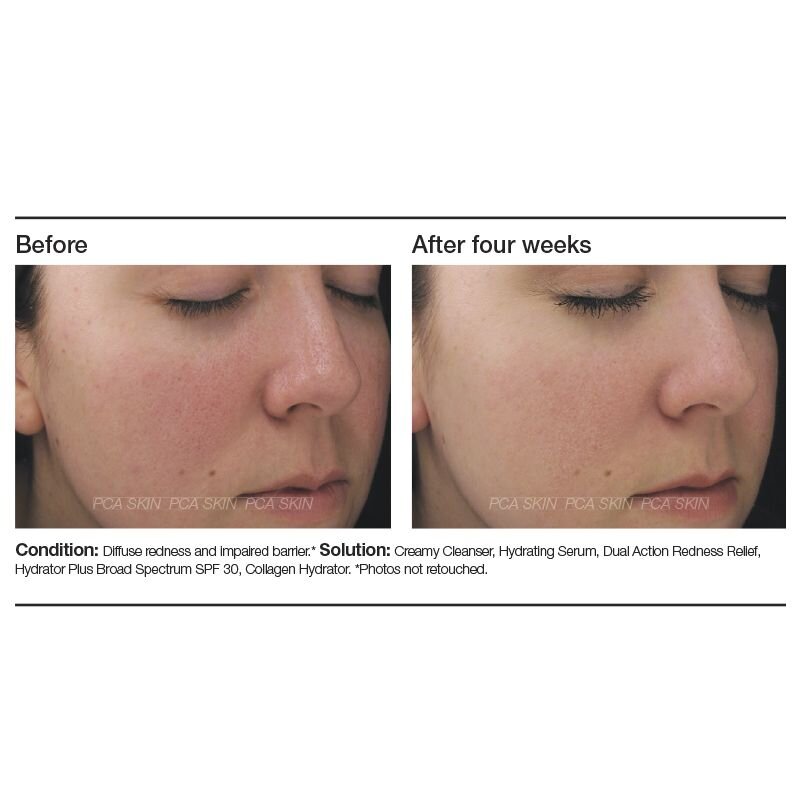 blemish control bar pca skin