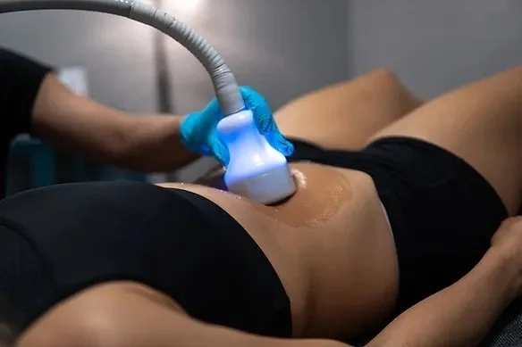 CryoSlimming body-contouring treatment in London