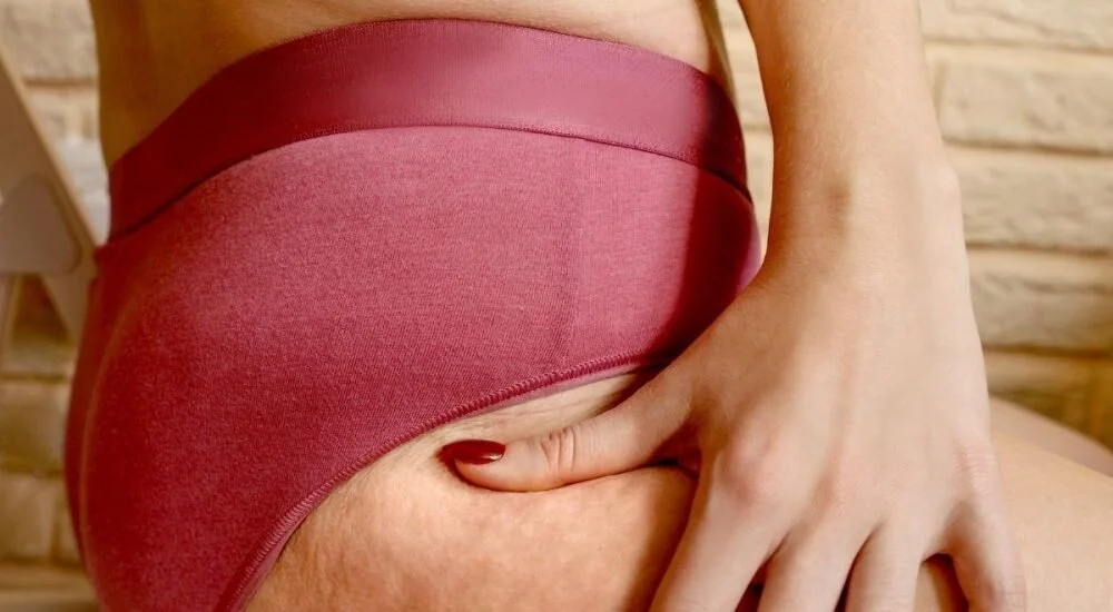 Cellulite: what is it and what can do you do about it?