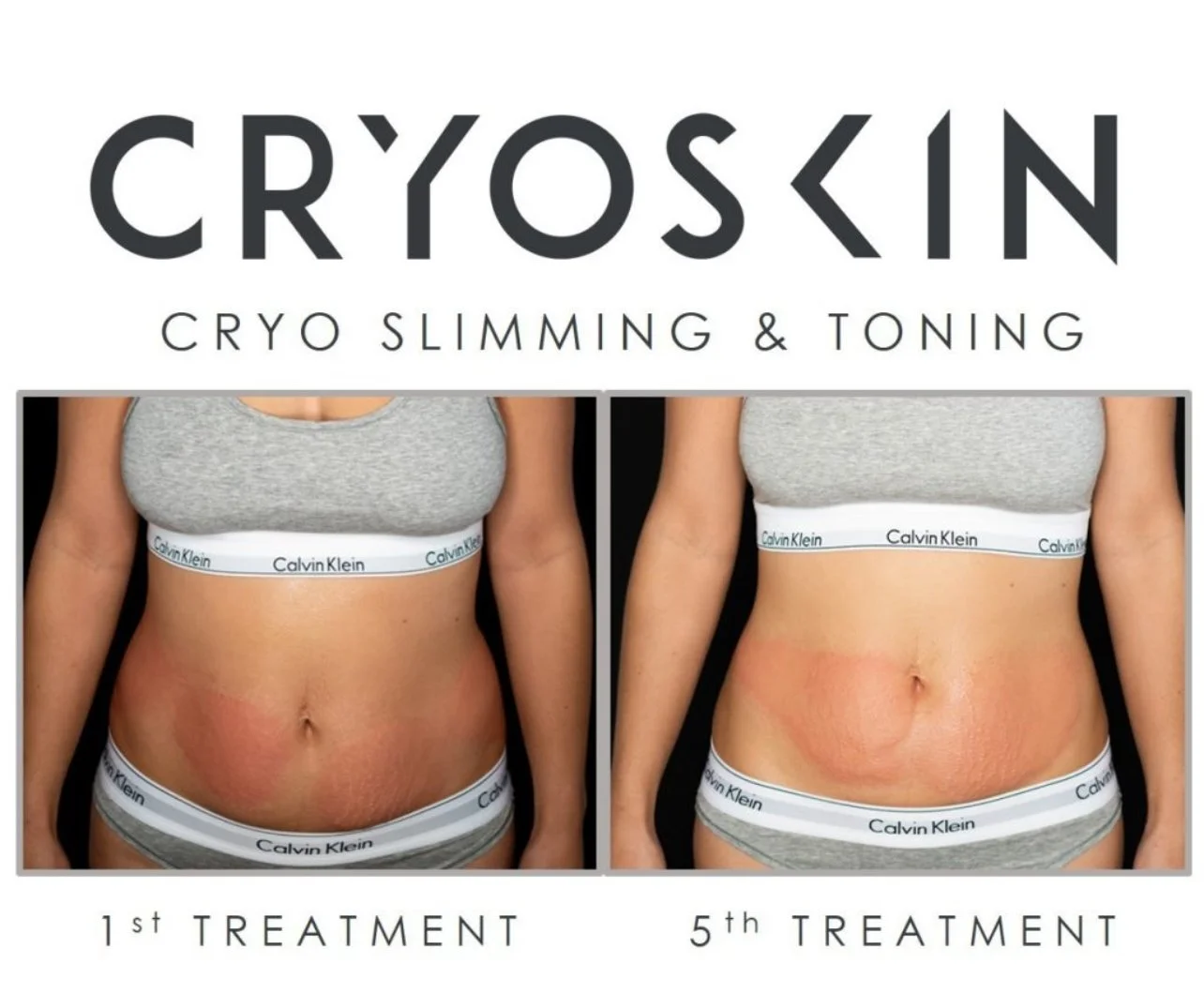 Sculpt Your Dream Body with CryoSkin CryoSlimming at LondonCryo