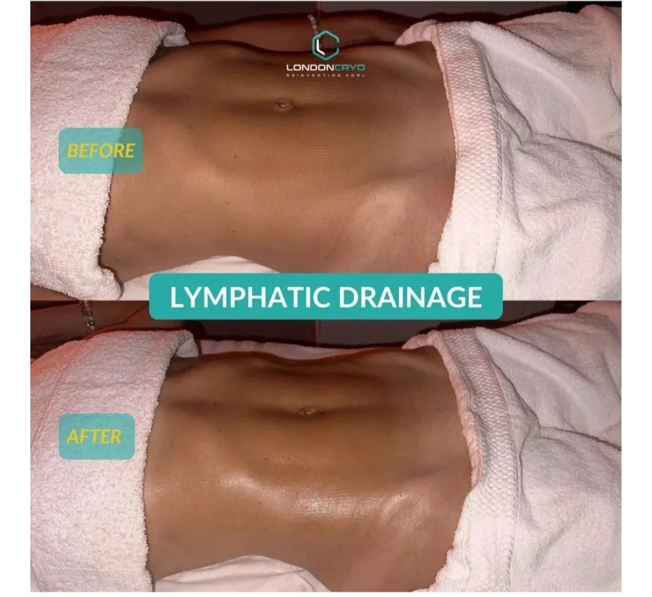 Lymphatic Drainage £99 - Limited Time