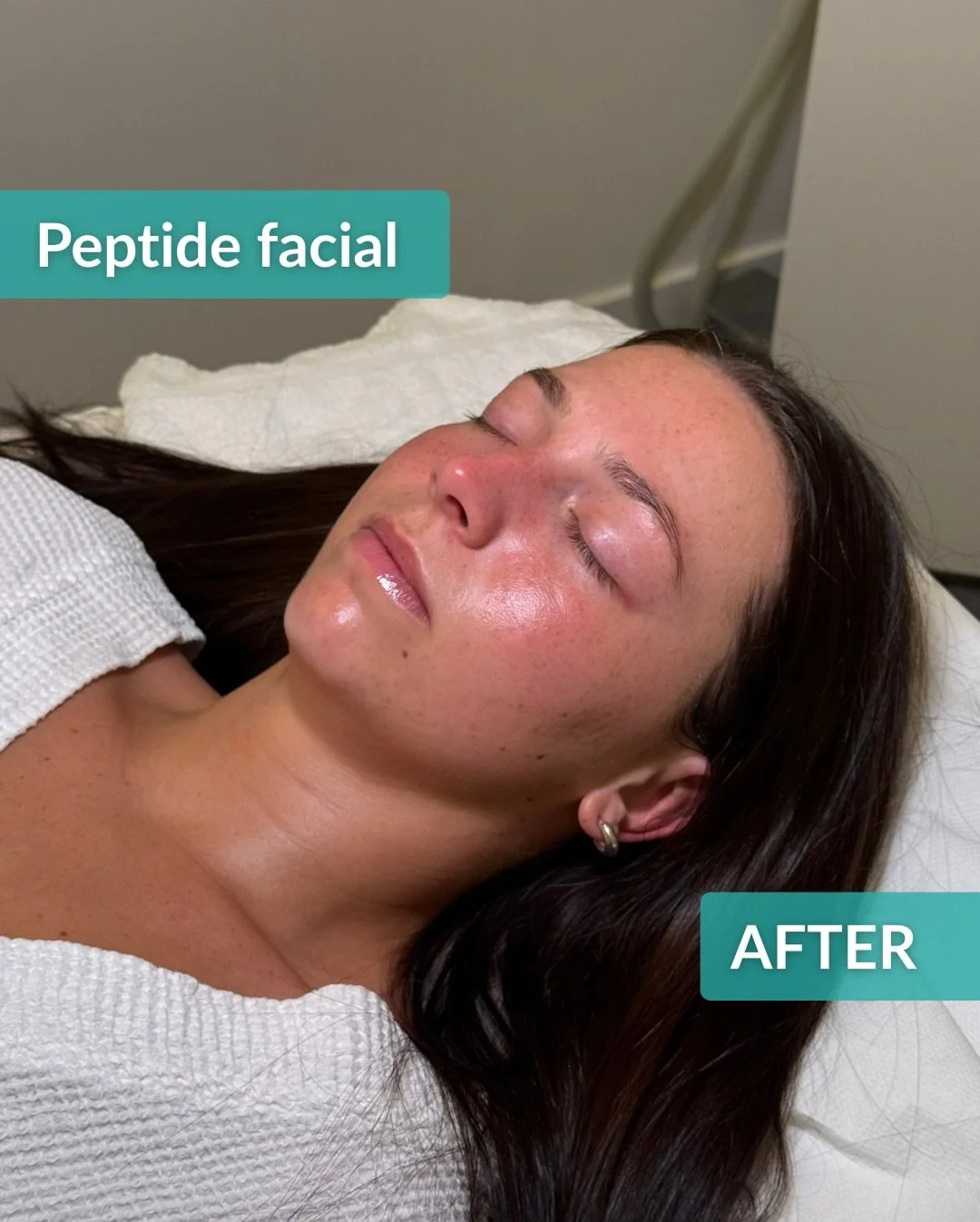 Before &rarr; After. One peptide facial.

Firmer skin.
Smoother texture.
That post-treatment glow ✨

Peptides work at a cellular level to support collagen production, improve elasticity and strengthen the skin barrier, which is why results don&rsquo;