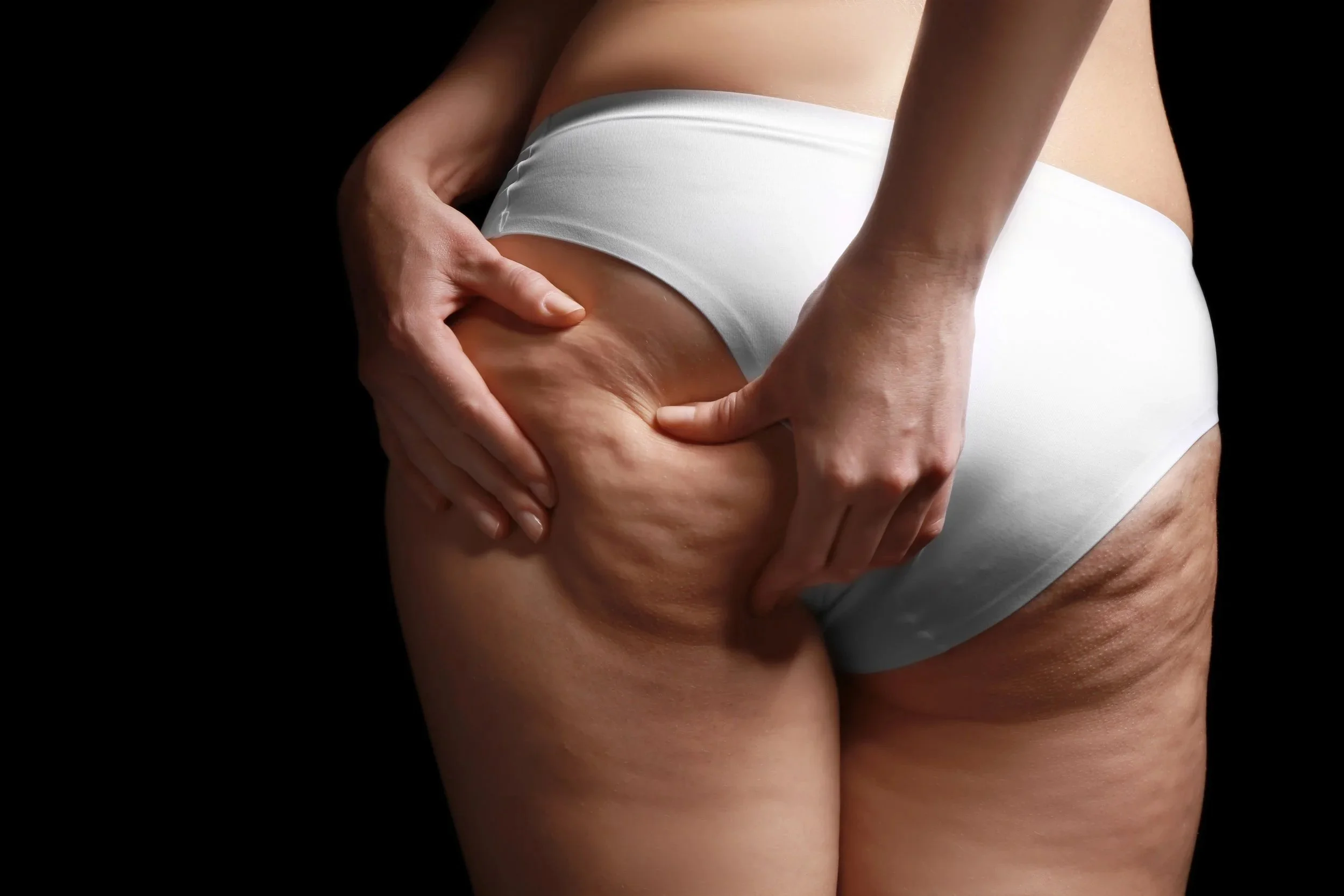 Natural skin texture and contour changes commonly associated with cellulite