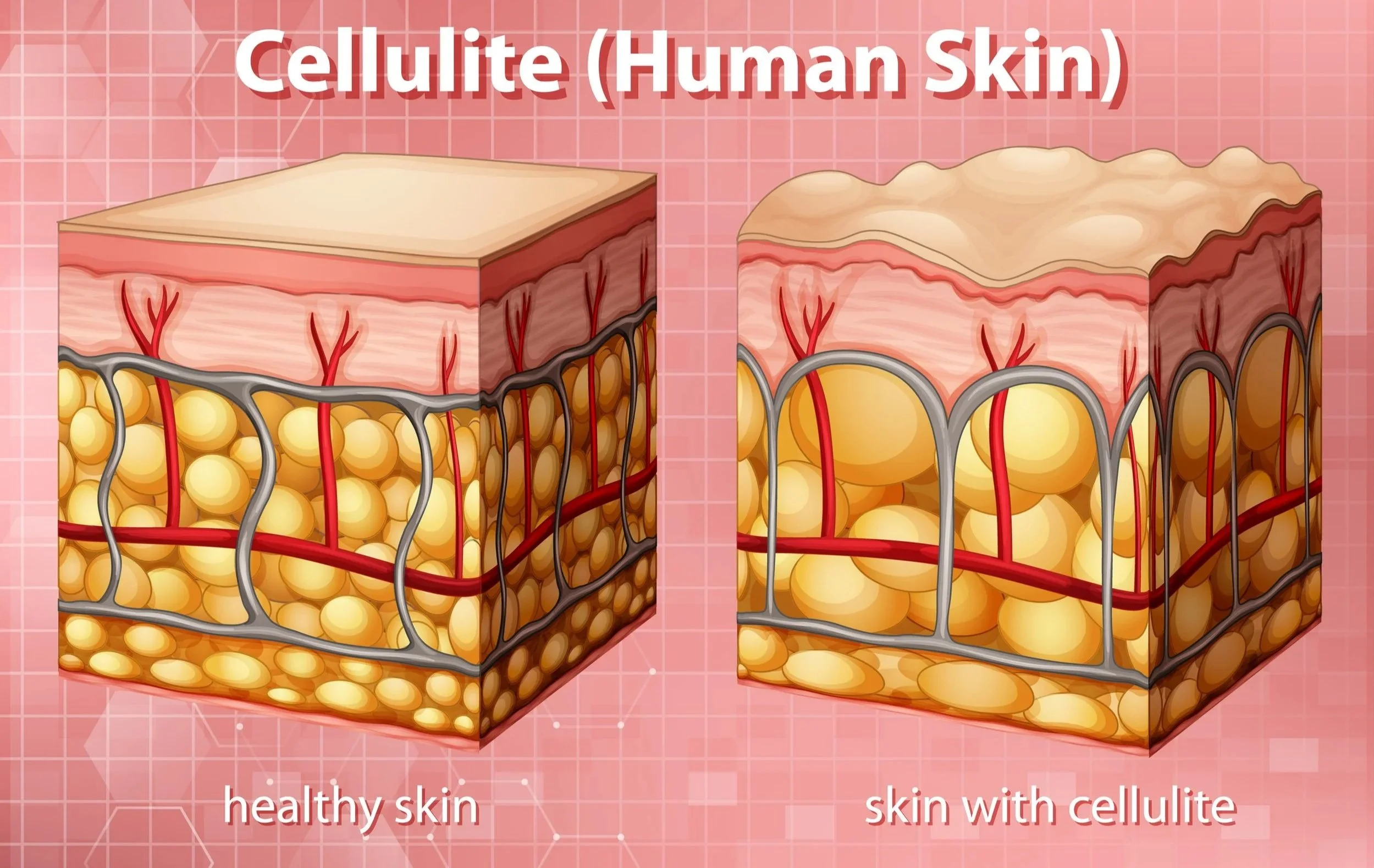 Illustration showing the difference between healthy skin structure and skin affected by cellulite, including fat cells and connective tissue”
