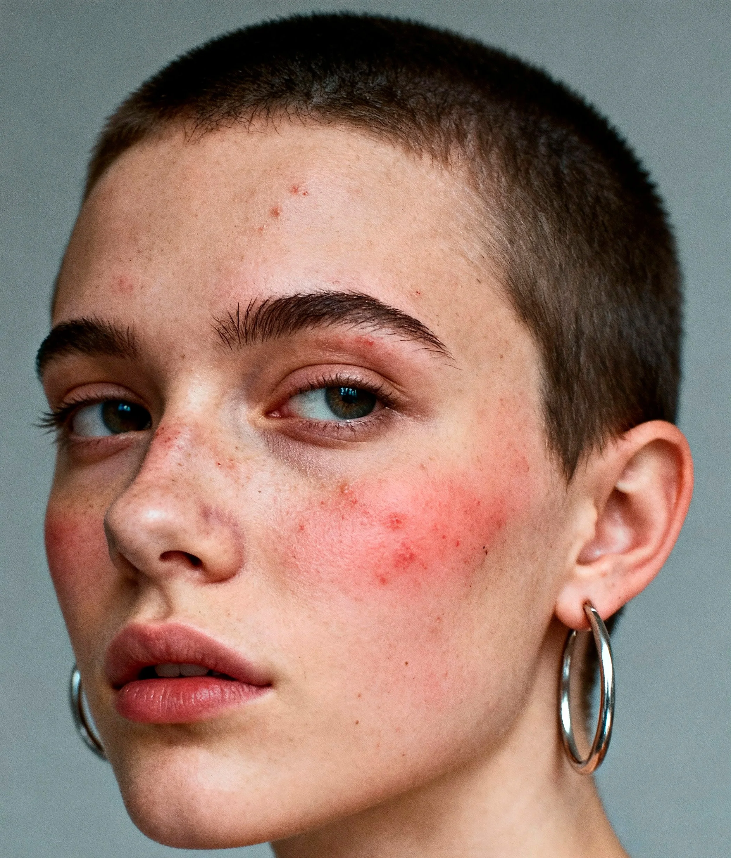 Person with natural facial skin texture showing acne or rosacea in everyday lighting