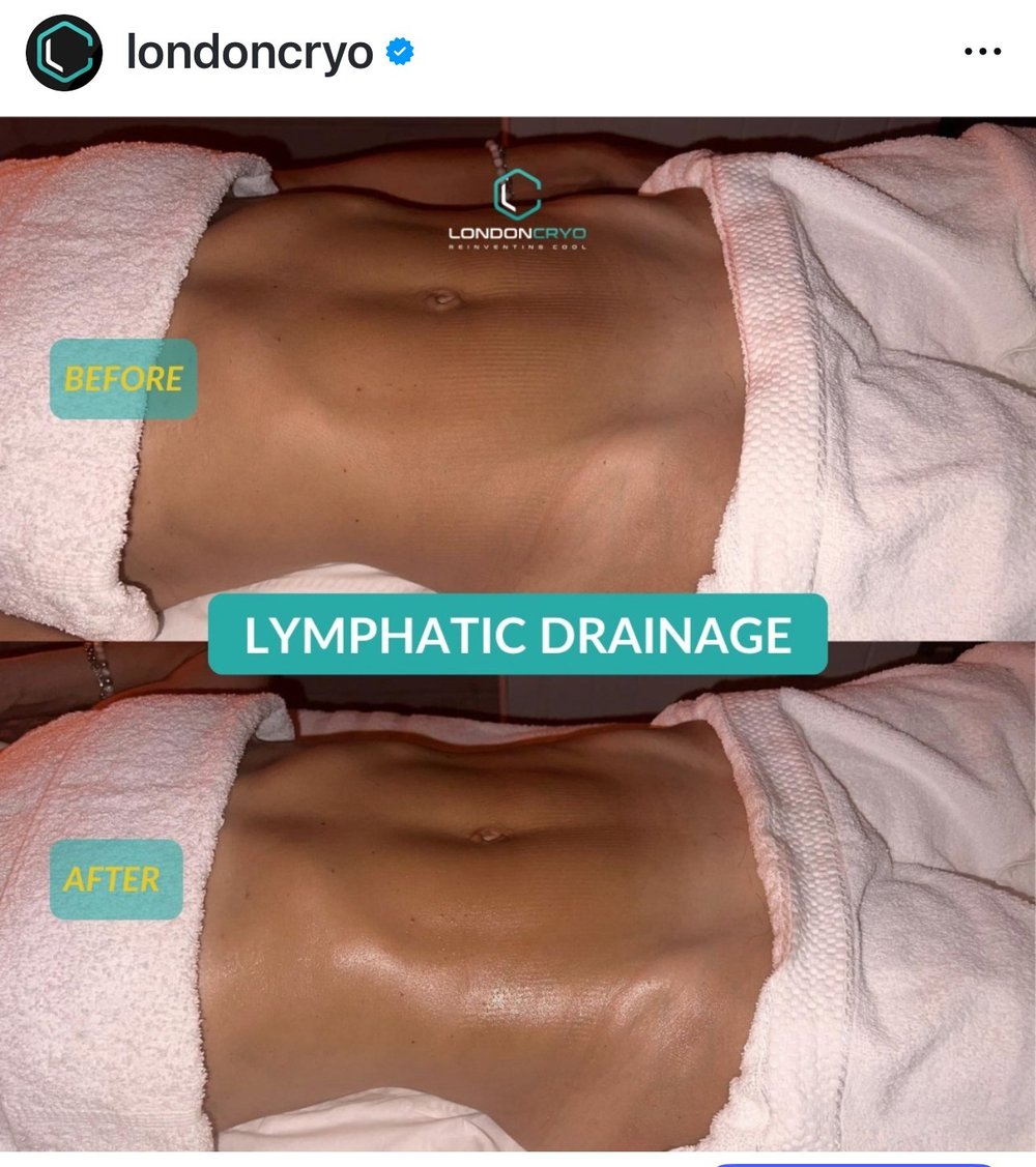 Real LondonCryo lymphatic drainage client result