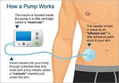 How Does an Insulin Pump Work: Types and How to Use It