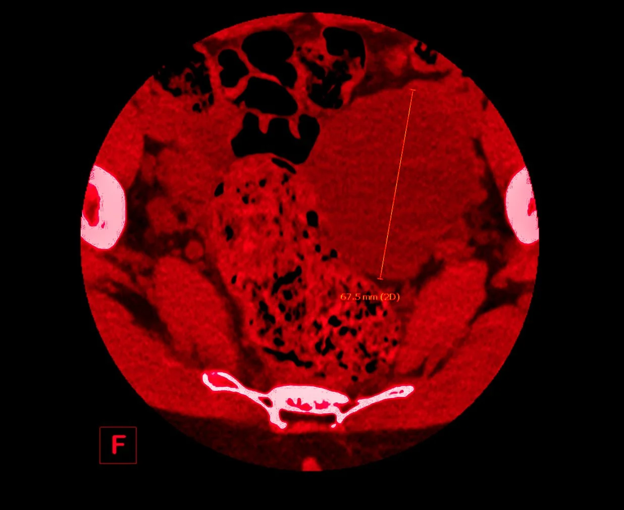 Confessions of a Bad-Backed Young Masc