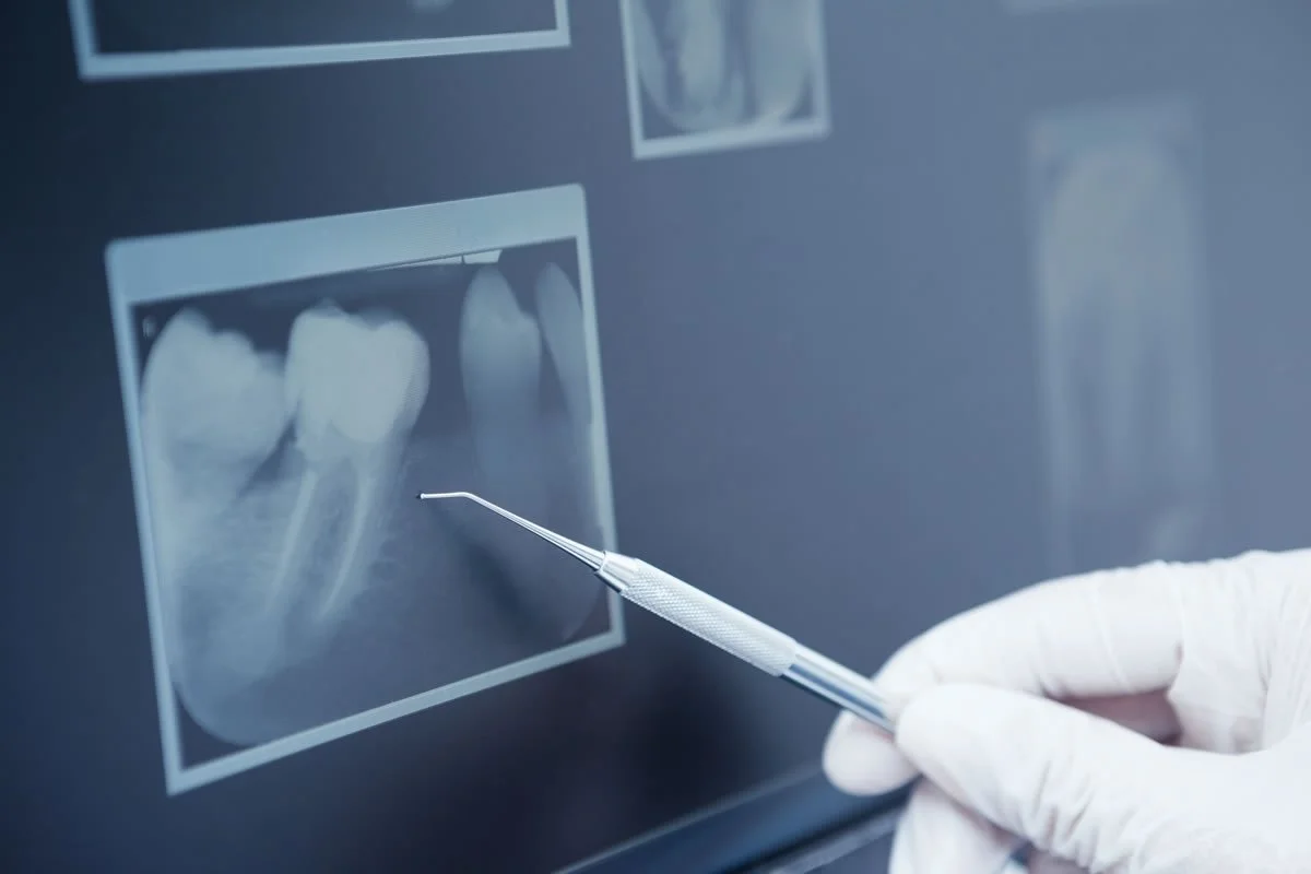 All About Dental X-rays 