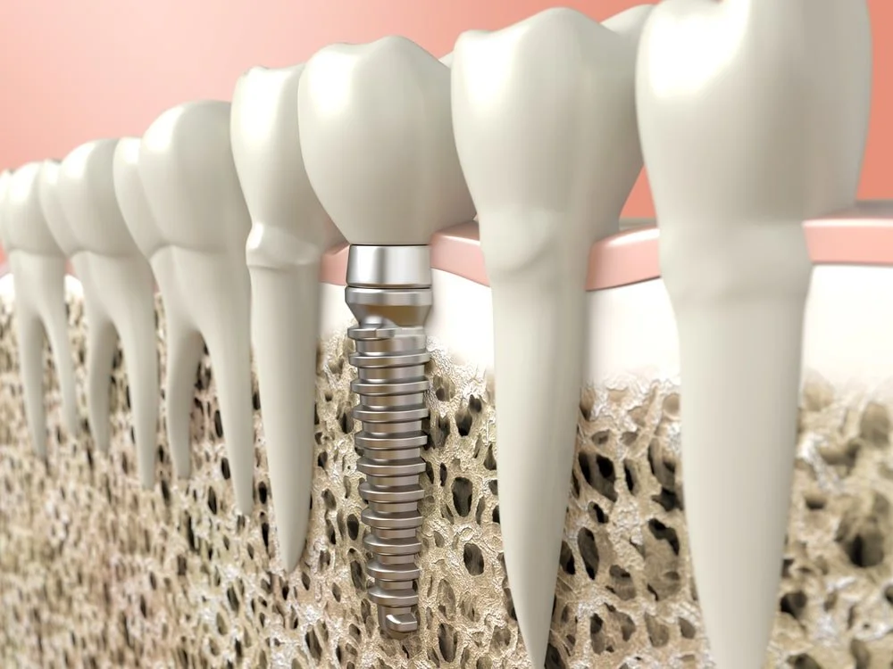 How Soon After Tooth Extraction Can I Have an Implant? 