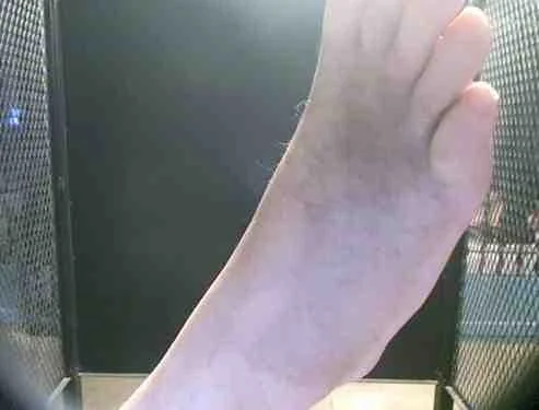A recent photo of Robert’s injured foot