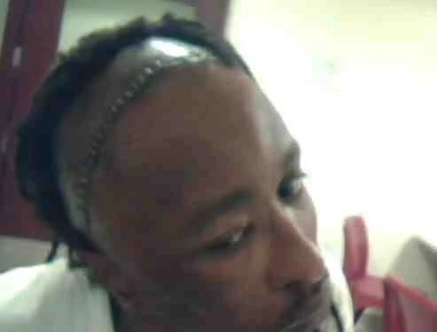 Vernell after brain surgery