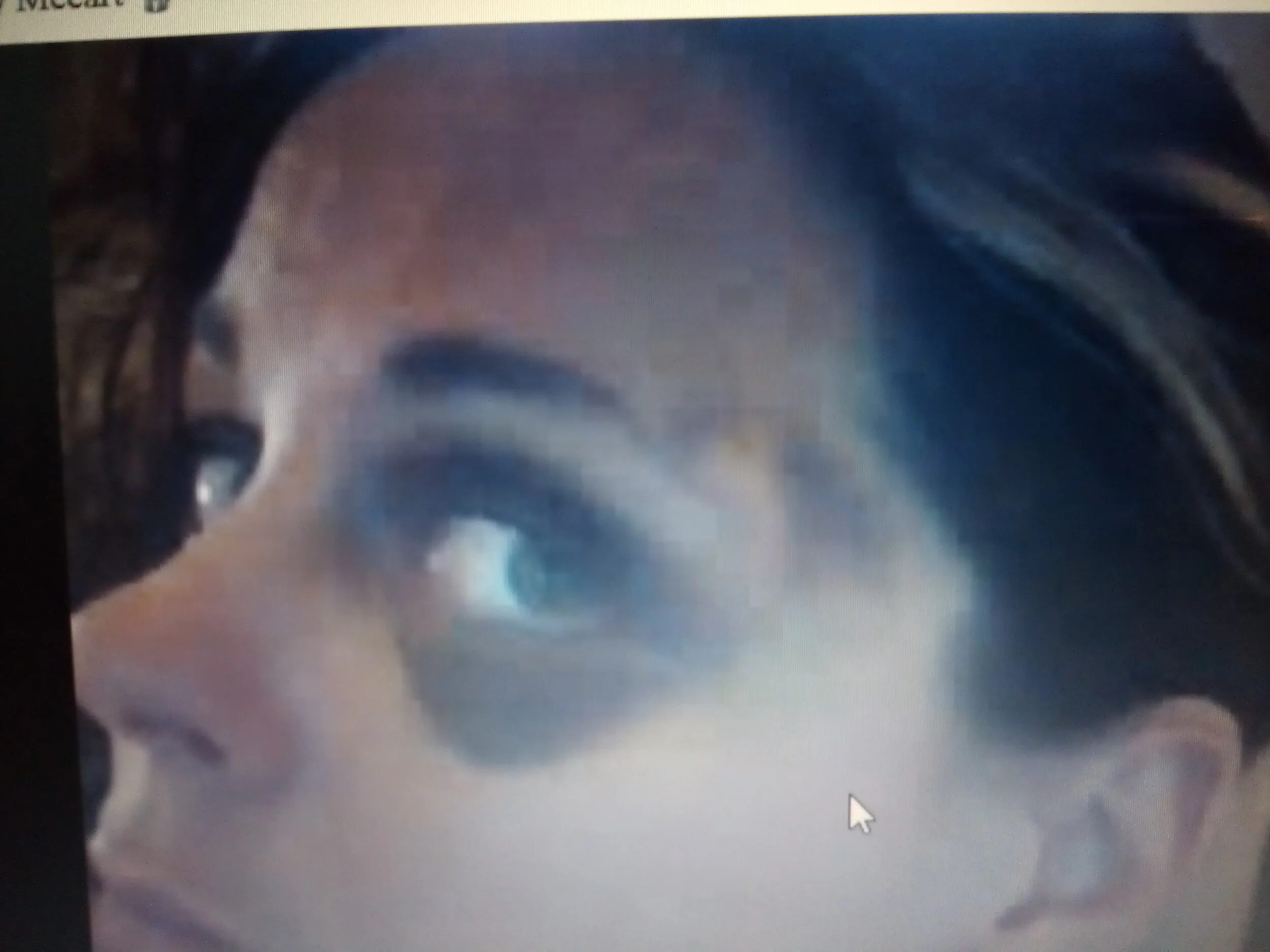 Bruise to temple and lump.jpg