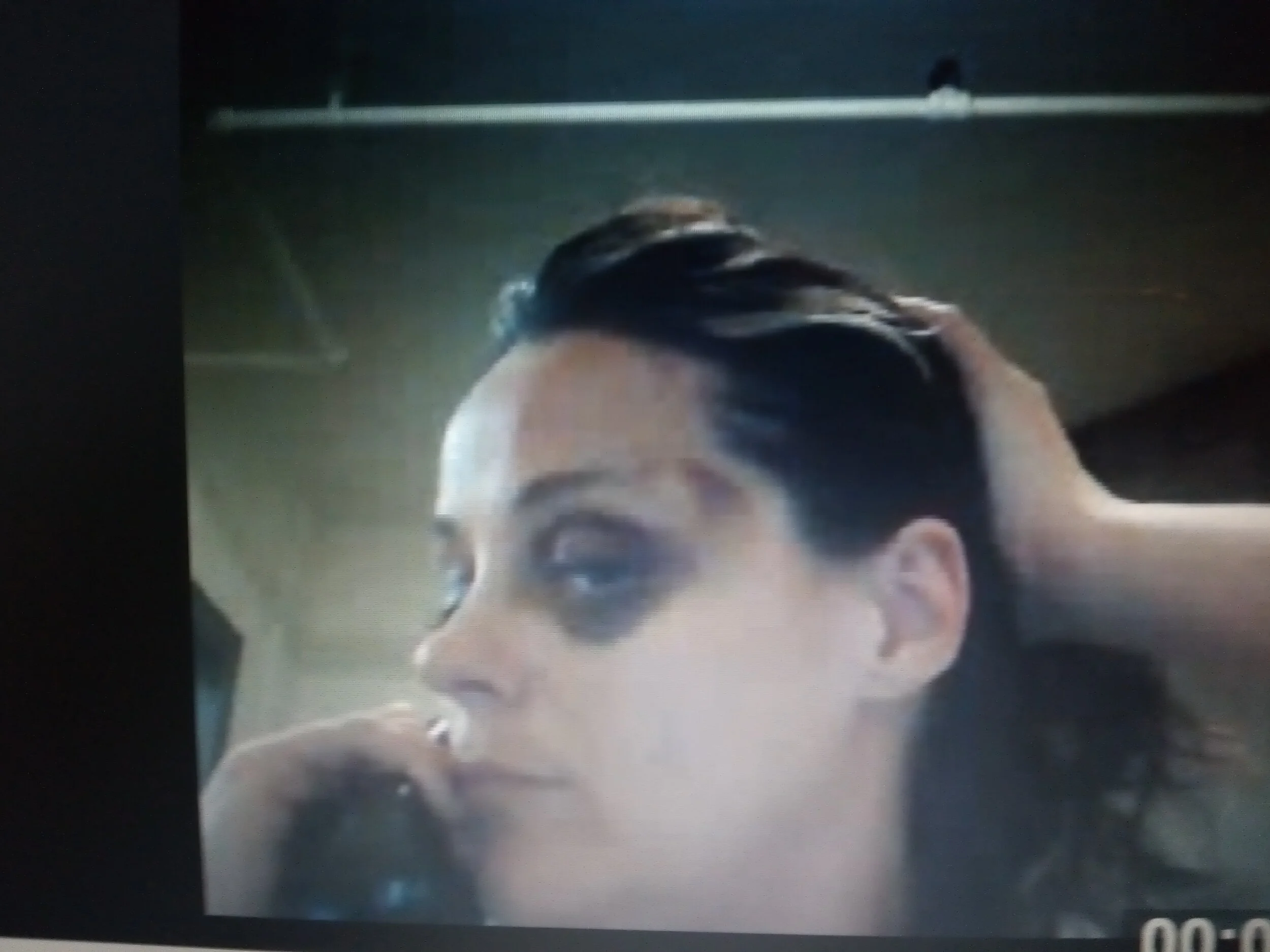 black eye and bruise to temple 1.jpg