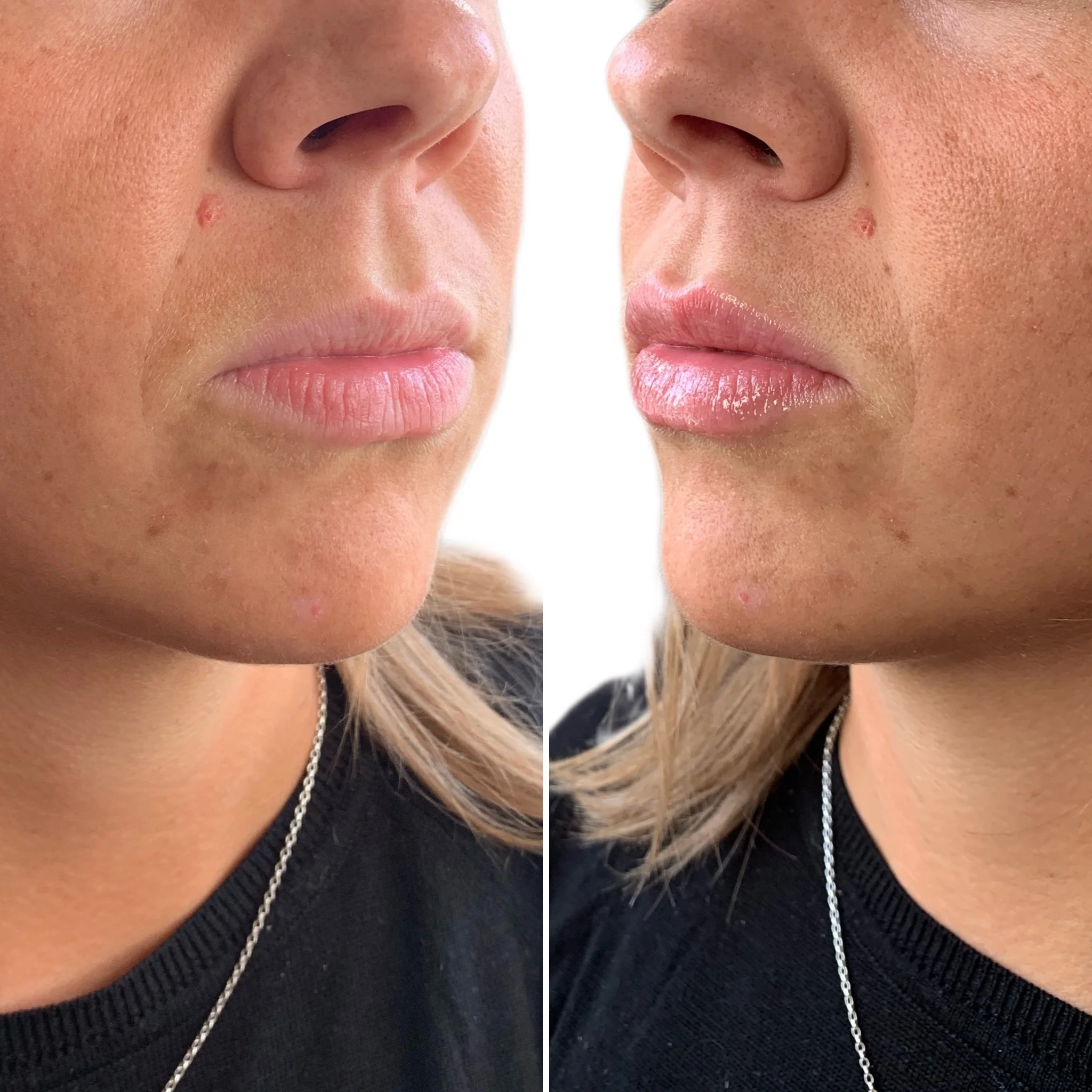 Lip filler