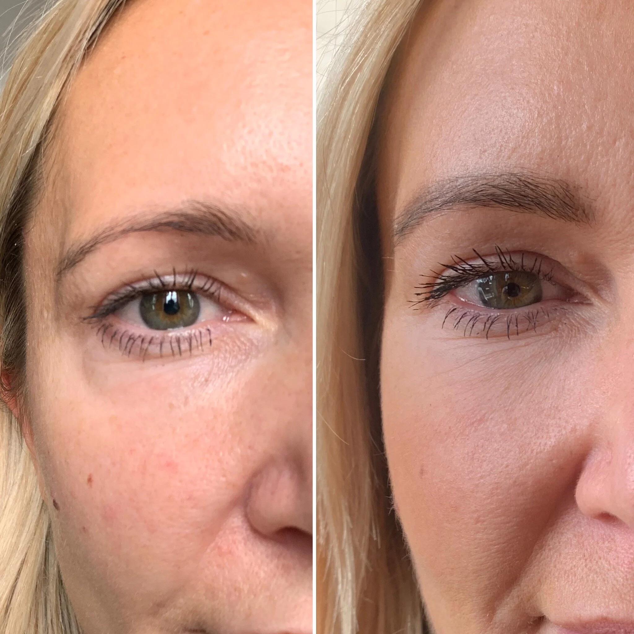 Tear trough filler