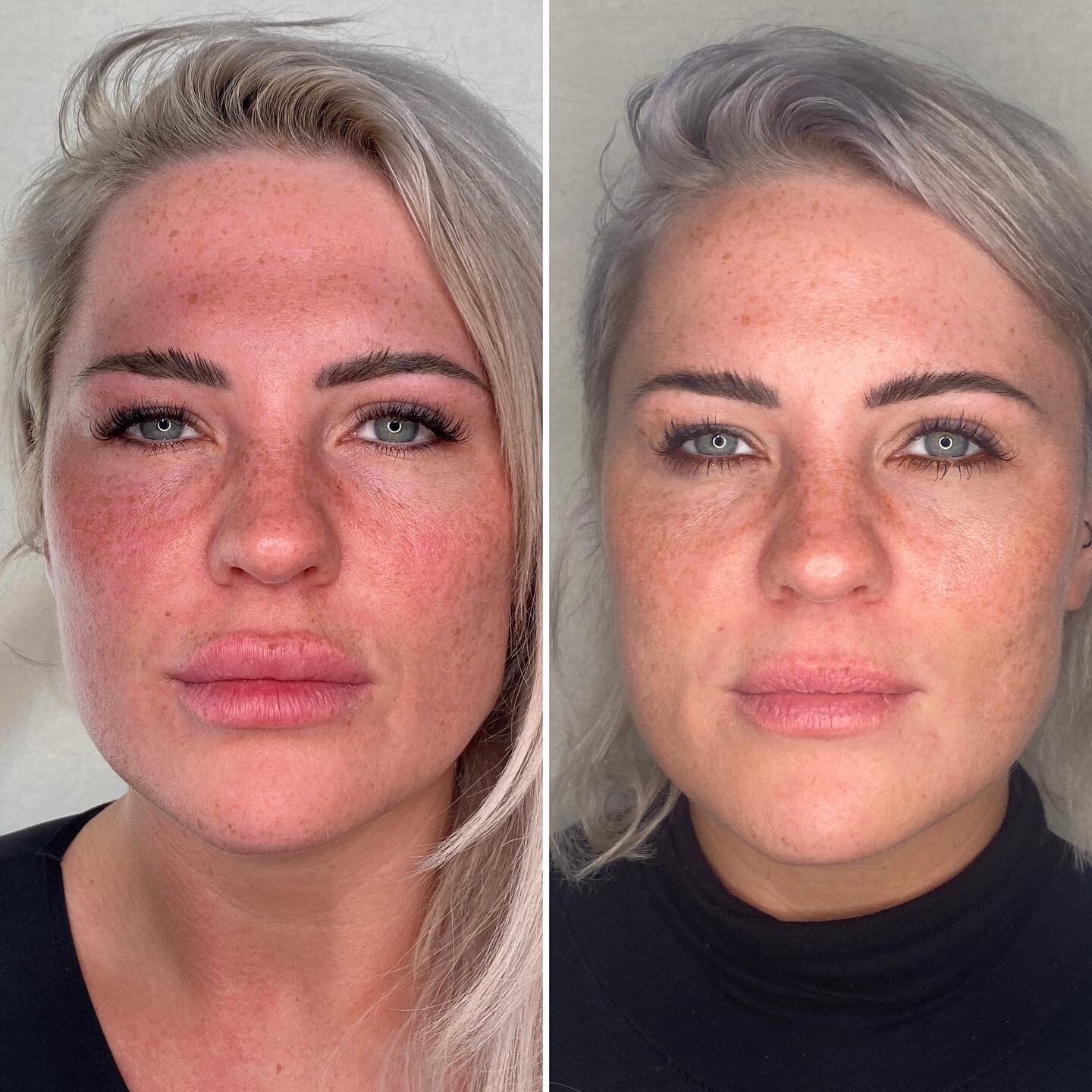 F I X I N G  L I P S
.
This client had filler placed by another injector, and the result wasn&rsquo;t great. You can see filler above the lip line - we call this the vermillion border - as well as poor balance of upper to lower lip ratio, which in ca