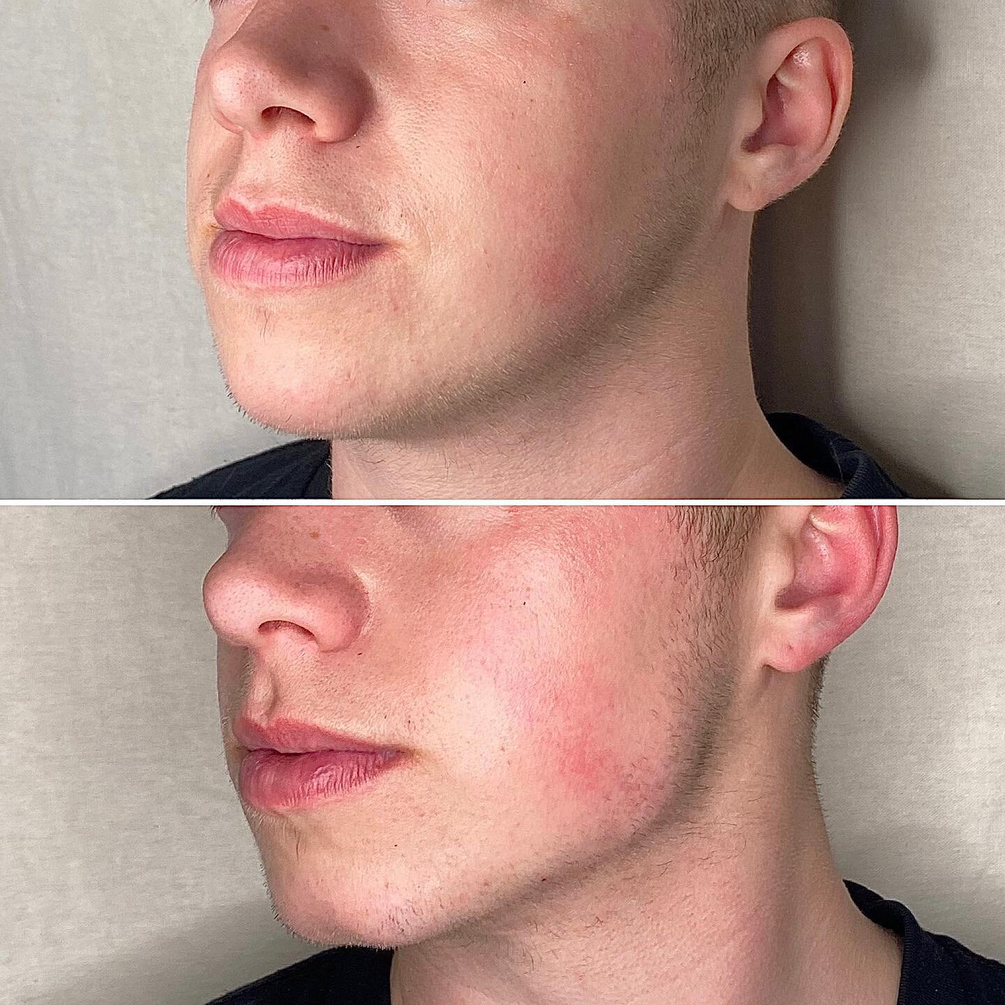 TRANS MASC JAW &amp; CHIN FILLER
.
My super awesome client has really kindly allowed me to post this. I used filler to masculinise his jawline and chin.
.
This will last him 12-18 months.
.
Clinics should not profit from gender dysphoria so I offer t