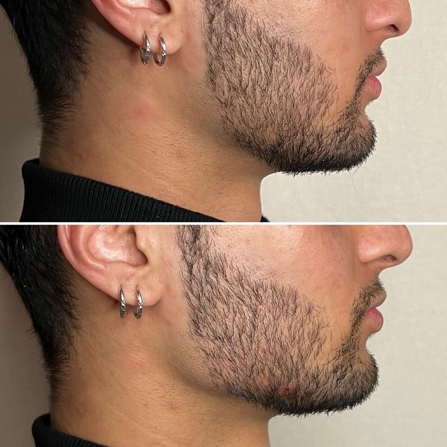 JAWLINE &amp; NOSE FILLER
.
Thanks to my lovely model for working with me. I used a firm dermal filler to sculpt a more defined jawline, and also to straighten the nose.
.
The jaw work was done with a microcannula, all through the one small entry poi
