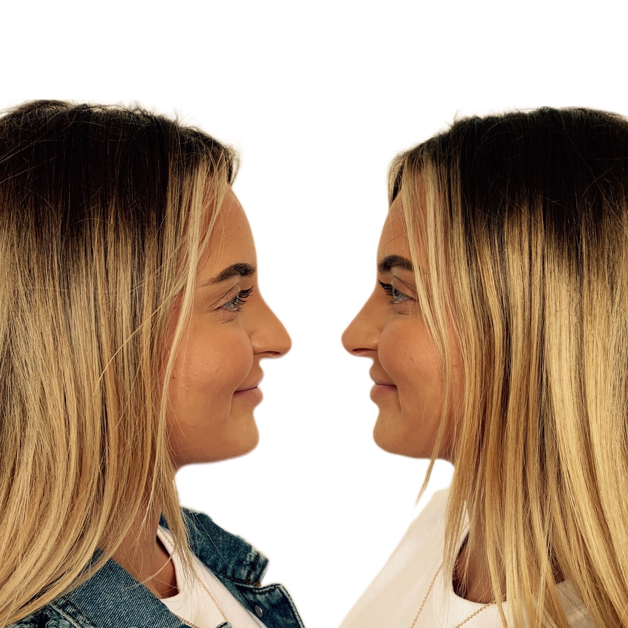 Nose filler to lift the tip and create a cute appearance.