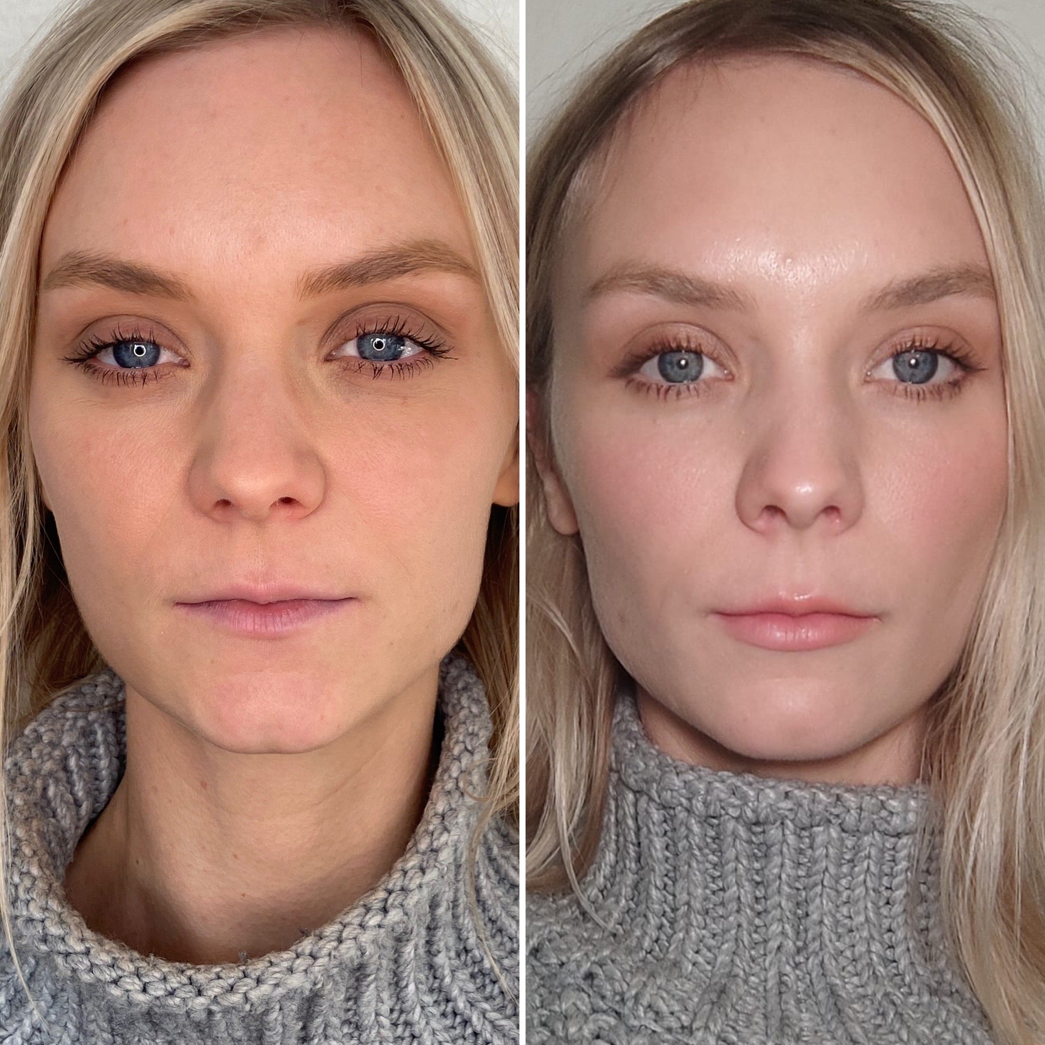 Very subtle lip filler, proving that filling lips can be plumped whilst avoiding the dreaded duck pout.
