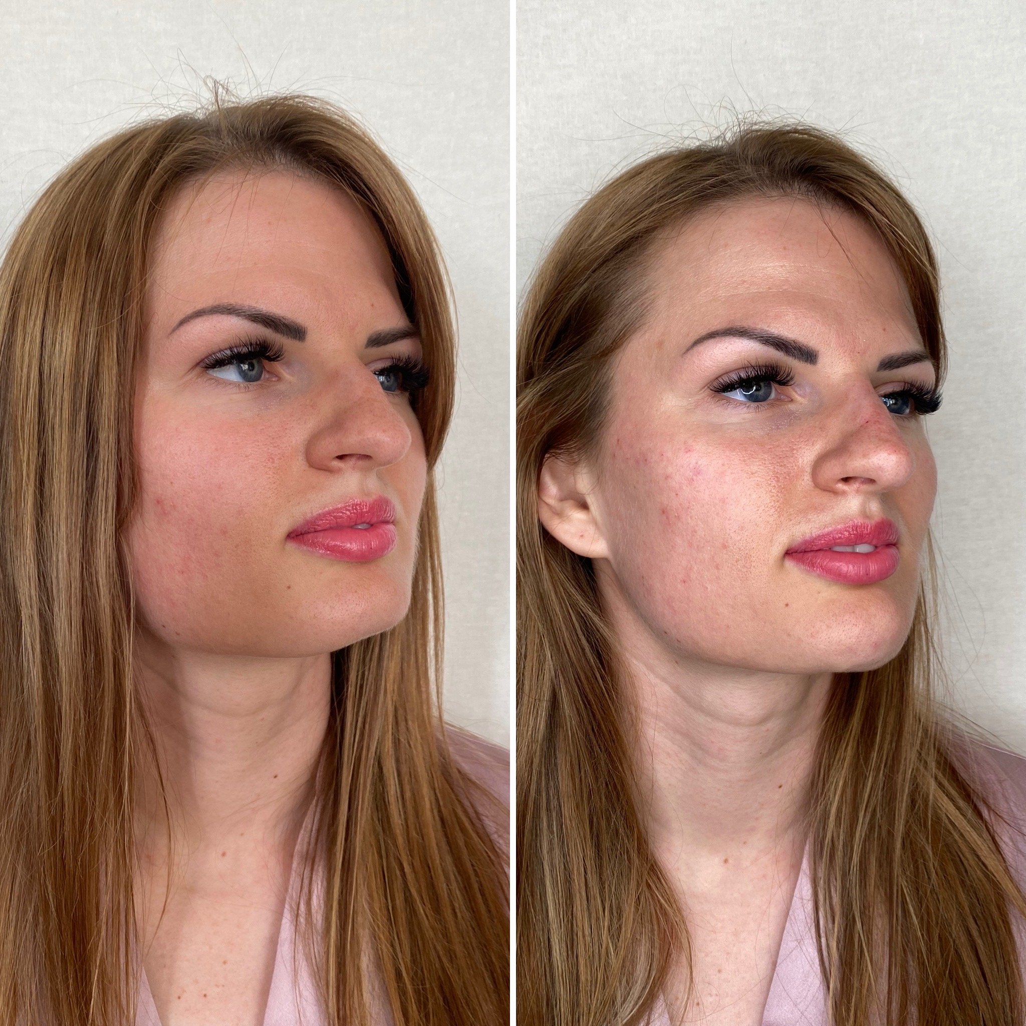 Filler to straighten the nose, and also to give symmetry to the vhin and jawline.