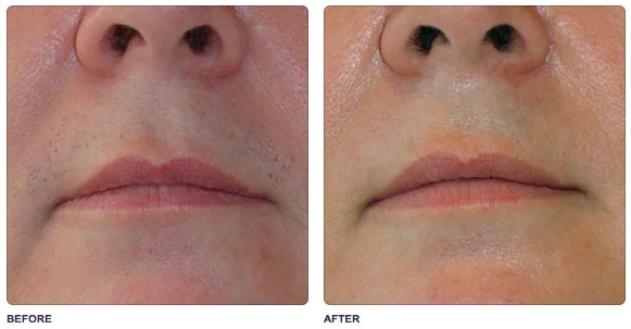 soprano-upperlip-hair-removal.jpg