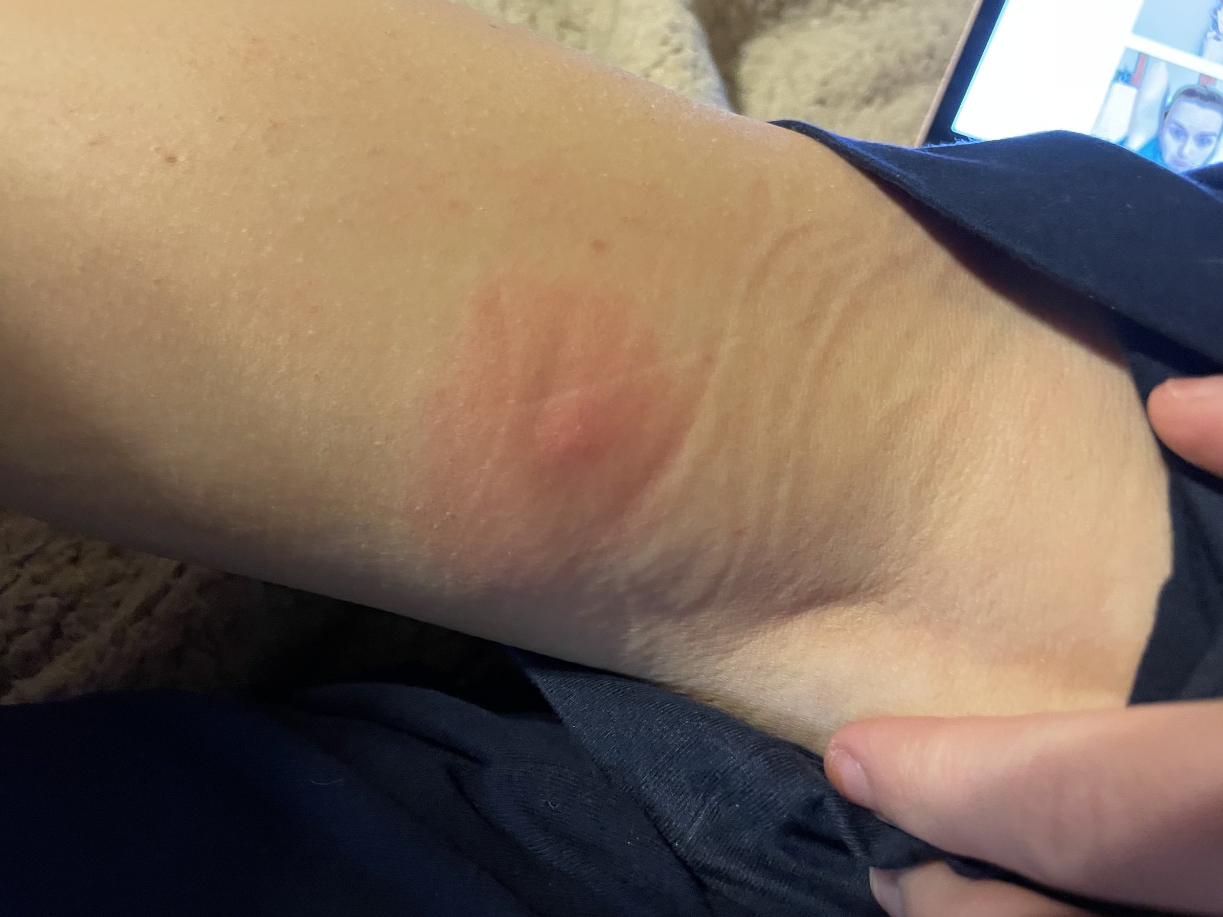 Cellulitis Infection On My Leg