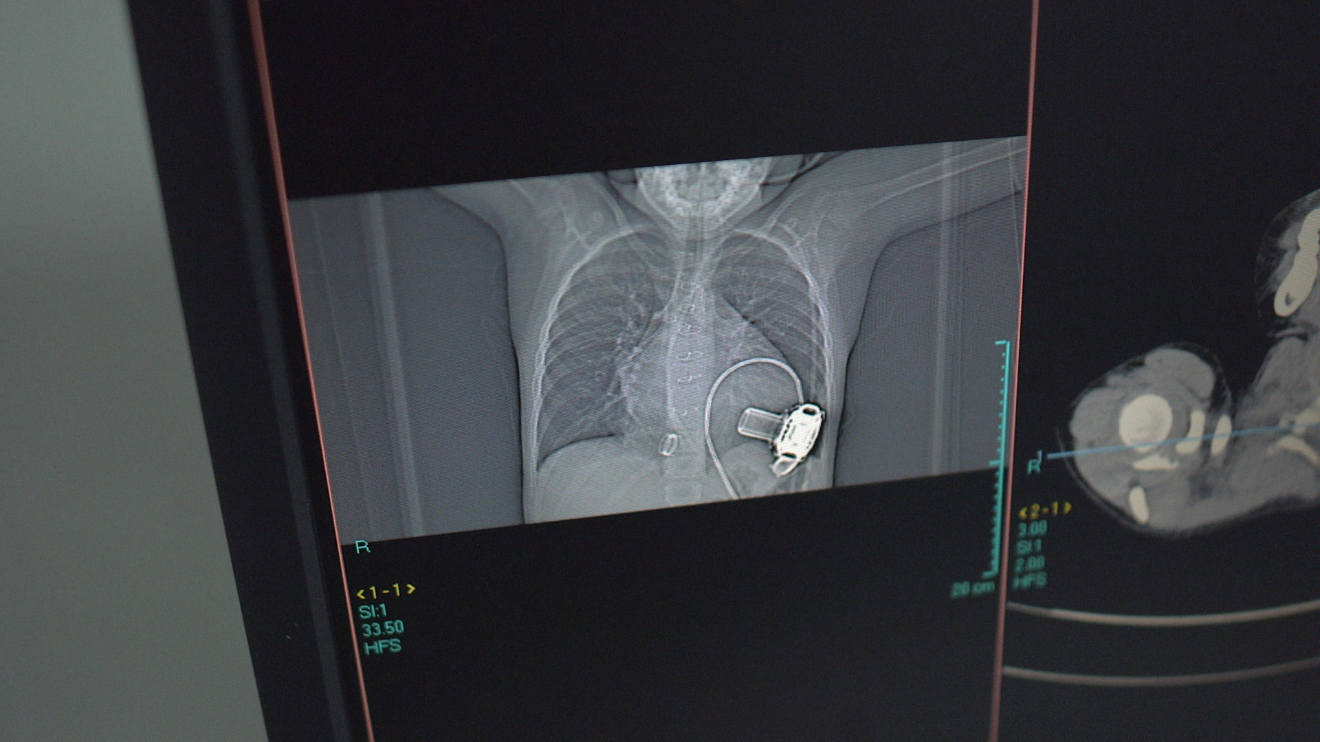 Xray.00970469.jpg