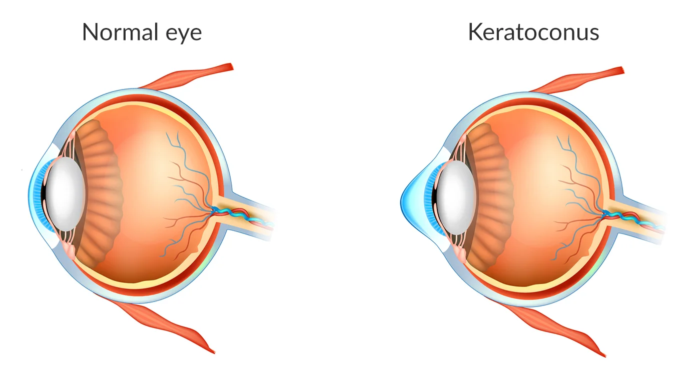 New Keratoconus Treatment Australia CAIRS Corneal Allogenic