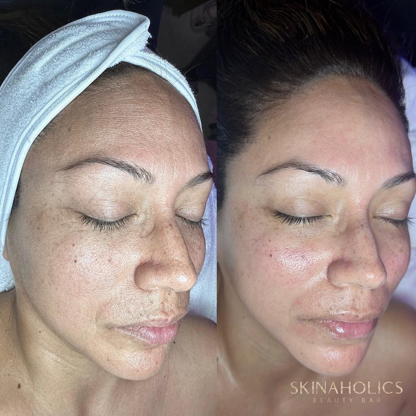 The power of Hydrafacial 🤌🏻 No downtime, all the results after just ONE treatment 😮&zwj;💨 

Add ons: Dermaplaning, ReGen GF Booster, Red LED Light Therapy, and Hydrojelly Mask

Literally took years off her skin and we are OBSESSED 😍

Book now, f