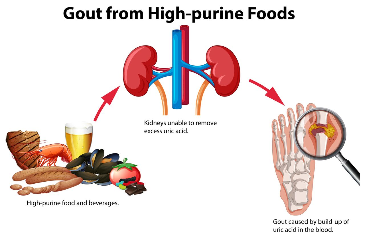 gout istock.png