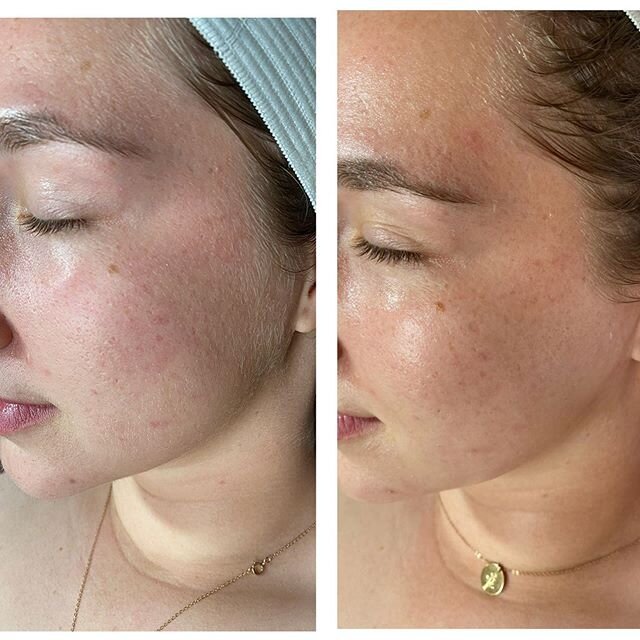 Before and after dermaplaning facial 😍 Her skin drank up all the hydration after we got rid of the dead skin and 🍑 fuzz! &bull;
Dermaplaning also helps your at home products become more effective!  By removing all of the dead skin, your products wi