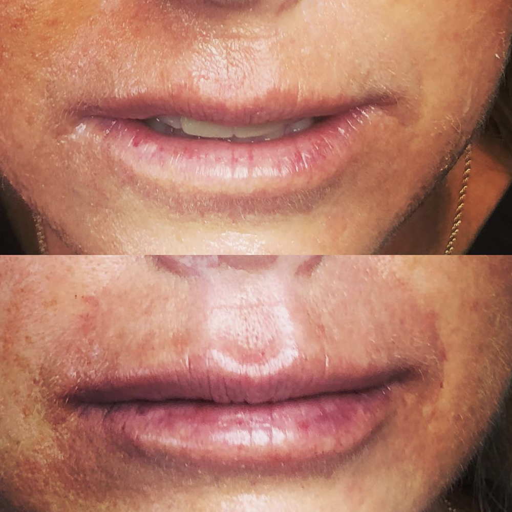 1 ml of filler to enhance the philtrum columns, vermillion border and add some hydration. Immediate Before (top) vs After (bottom)