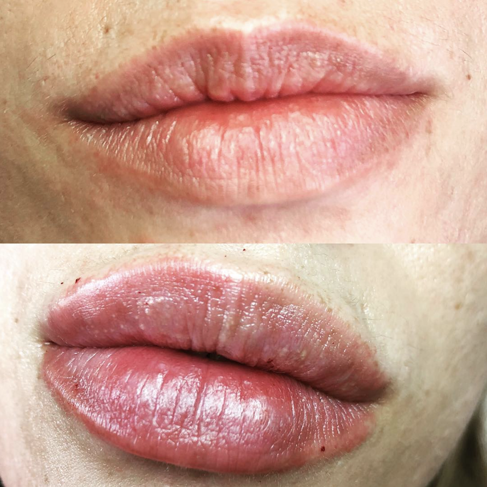 1 ml of filler over 2 sittings to even and plump these already beautiful lips! Before (top) vs After (bottom)