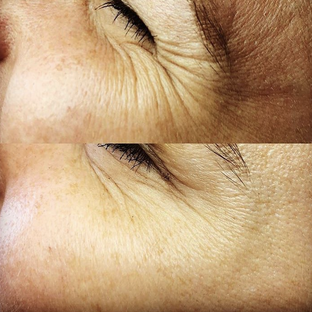 A few units of botox in the crows feet to visibly reduce wrinkles and in turn give your face a more youthful appearance. Before (top) vs After (bottom)