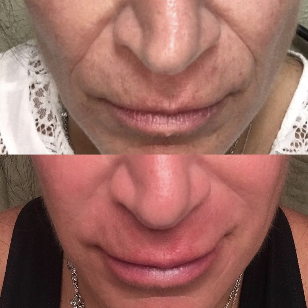 A few syringes of filler has the ability to take years off your appearance, leaving you feeling and looking refreshed, not over done! Before (top) vs After (bottom)