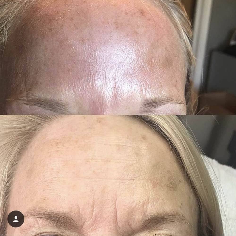 A few units of botox will keep you looking refreshed! Before (bottom) vs After (top)
