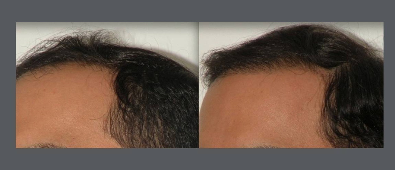 neograft_male_client_hela.png