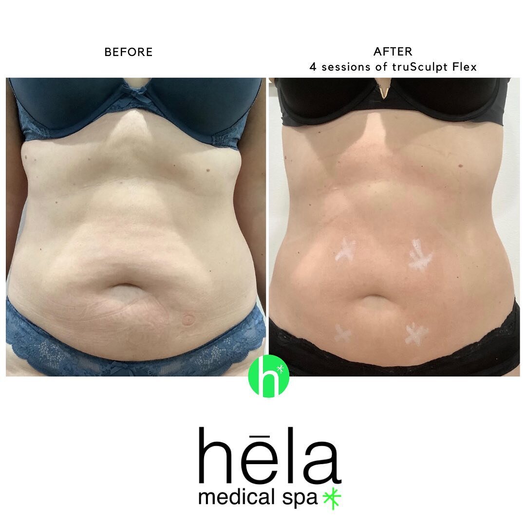 It&rsquo;s time to flex your muscles with TruSculptFLEX at Hela! 💪💪💪
TruSculpt flex is a muscle sculpting device that offers personalized treatments based on patient fitness level, shape, and goals. 
Only truSculpt flex with Multi-Directional Stim