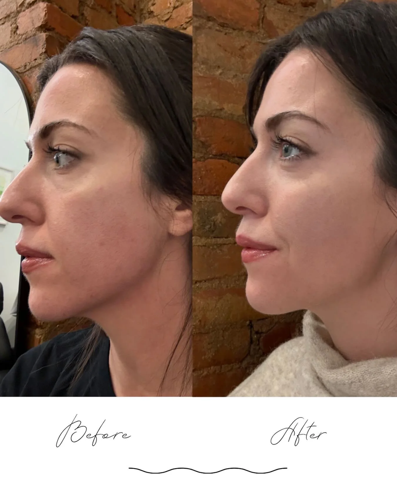 👀 Can you spot the difference?

No makeup and no filter in either photo. This transformation came from just 1 Perfect Derma Peel and 1 chin/jawline balancing treatment. 

The result? Radiant skin. Refined contours. ✨

Pro-Tip: The Perfect Derma Peel