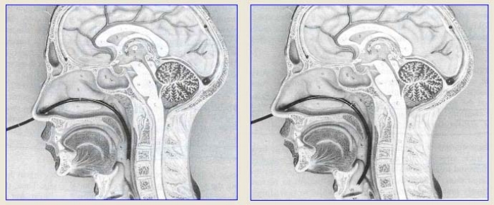 transnasal_scope_pass_sec_medical_speech_pathology.jpg