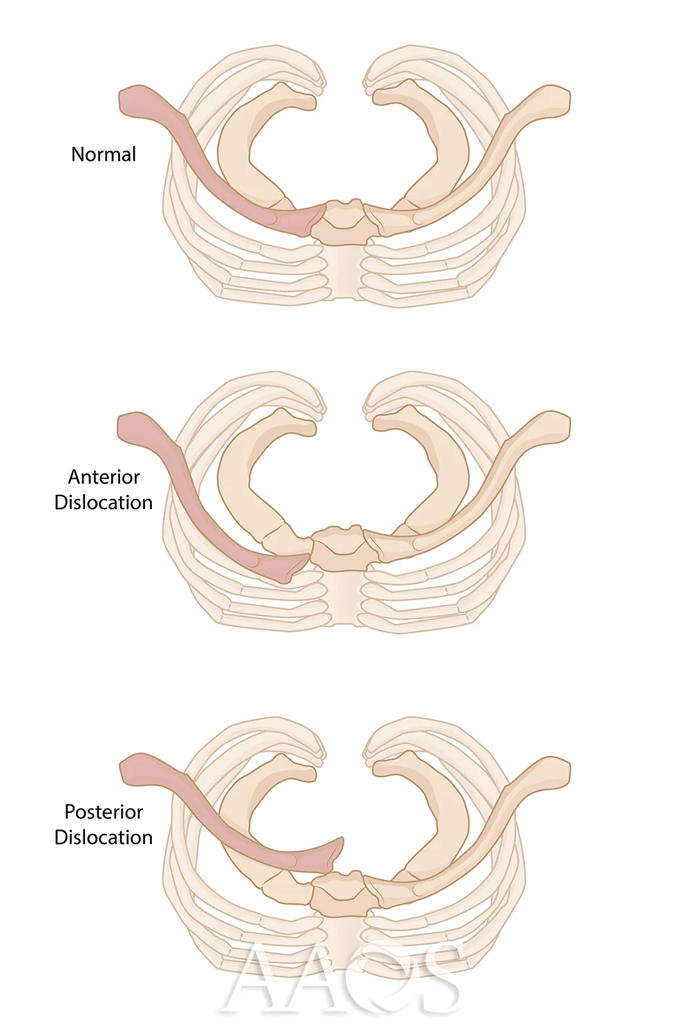 Dislocated Sternoclavicular Joint