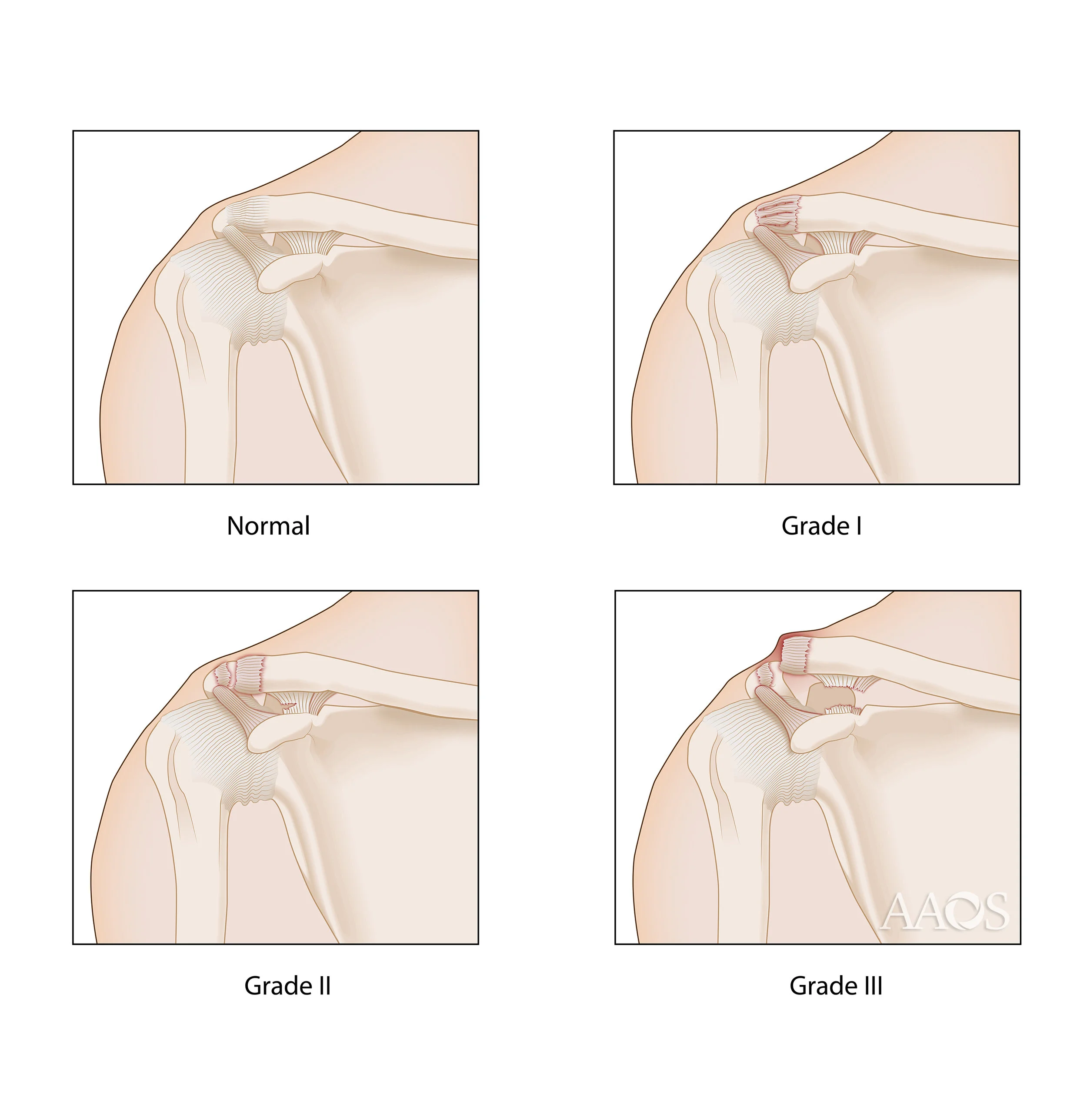 Shoulder Separation Grades