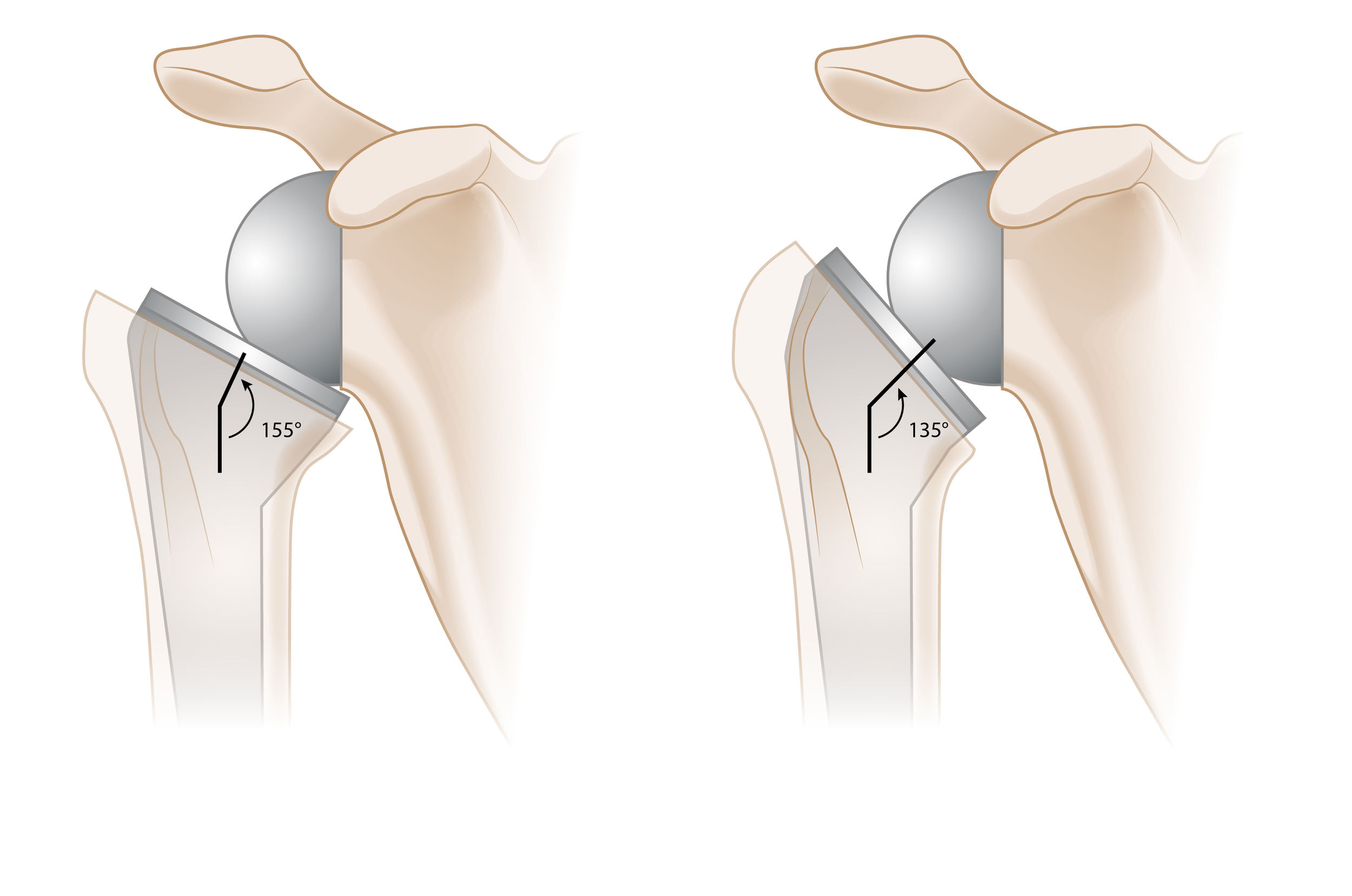 Reverse Shoulder Arthroplasty Prosthesis Comparison
