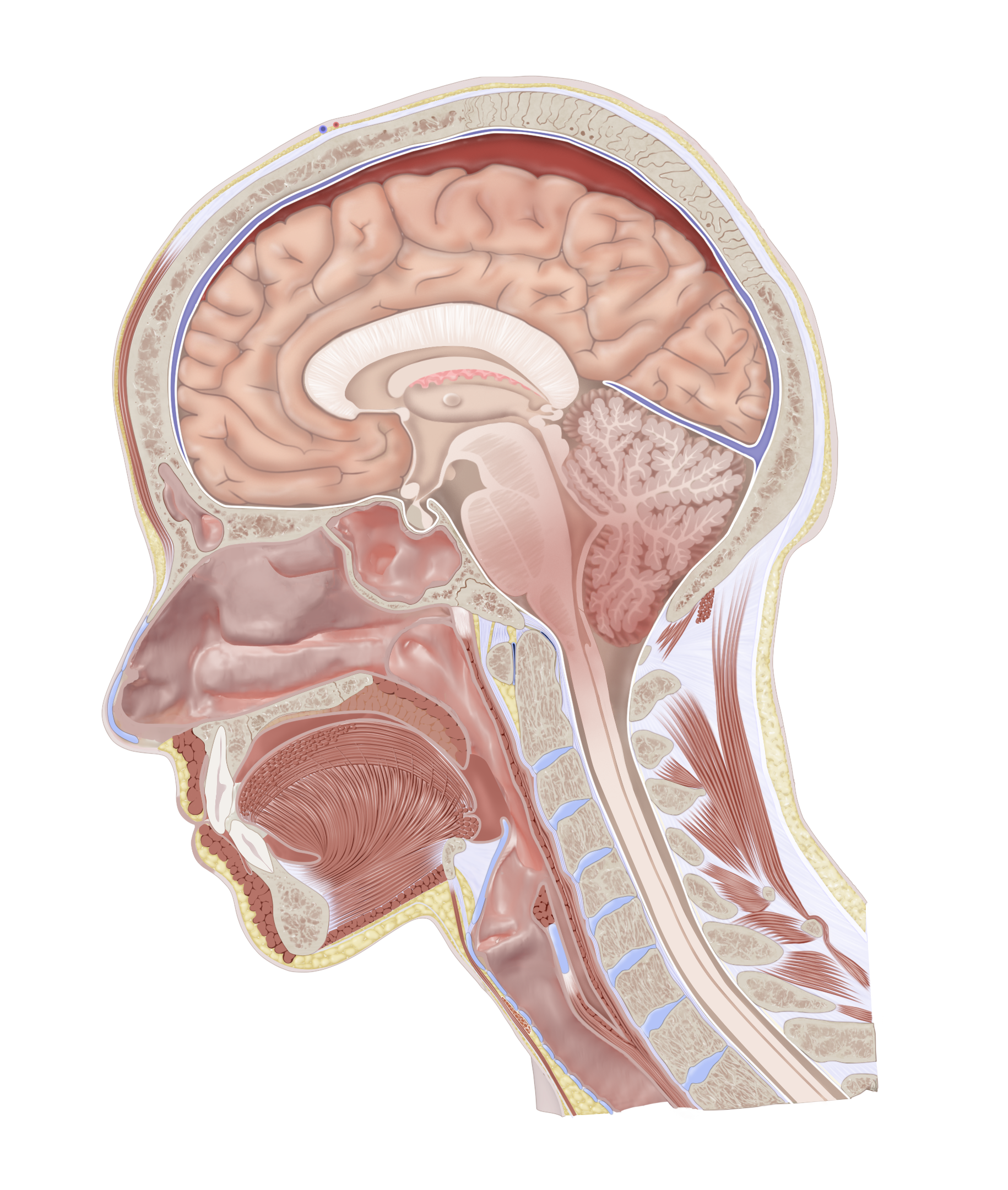 Subdural Hematoma in Head Cross Section